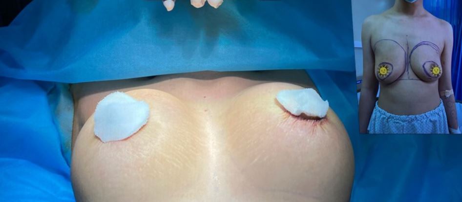 Tiến hành phẫu thuật nâng ngực chảy xệ