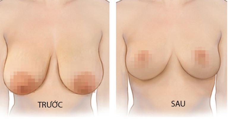 Trước và sau khi phẫu thuật nâng ngực chảy xệ