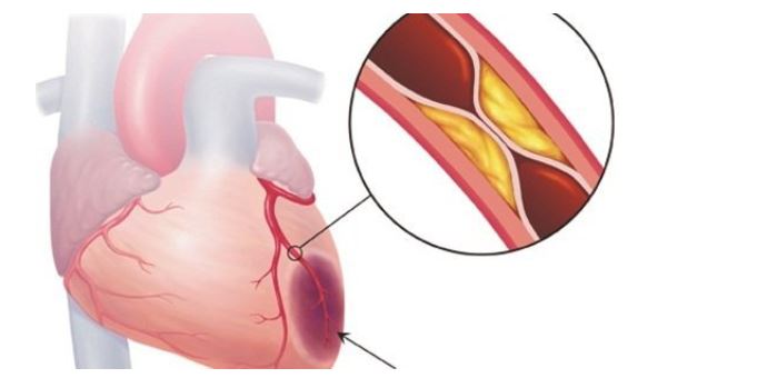 Đau ngực - bệnh lý liên quan đến tim mạch