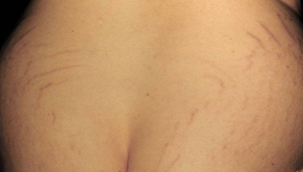 Ngực bị rạn gây mất tự tin ở chị em phụ nữ